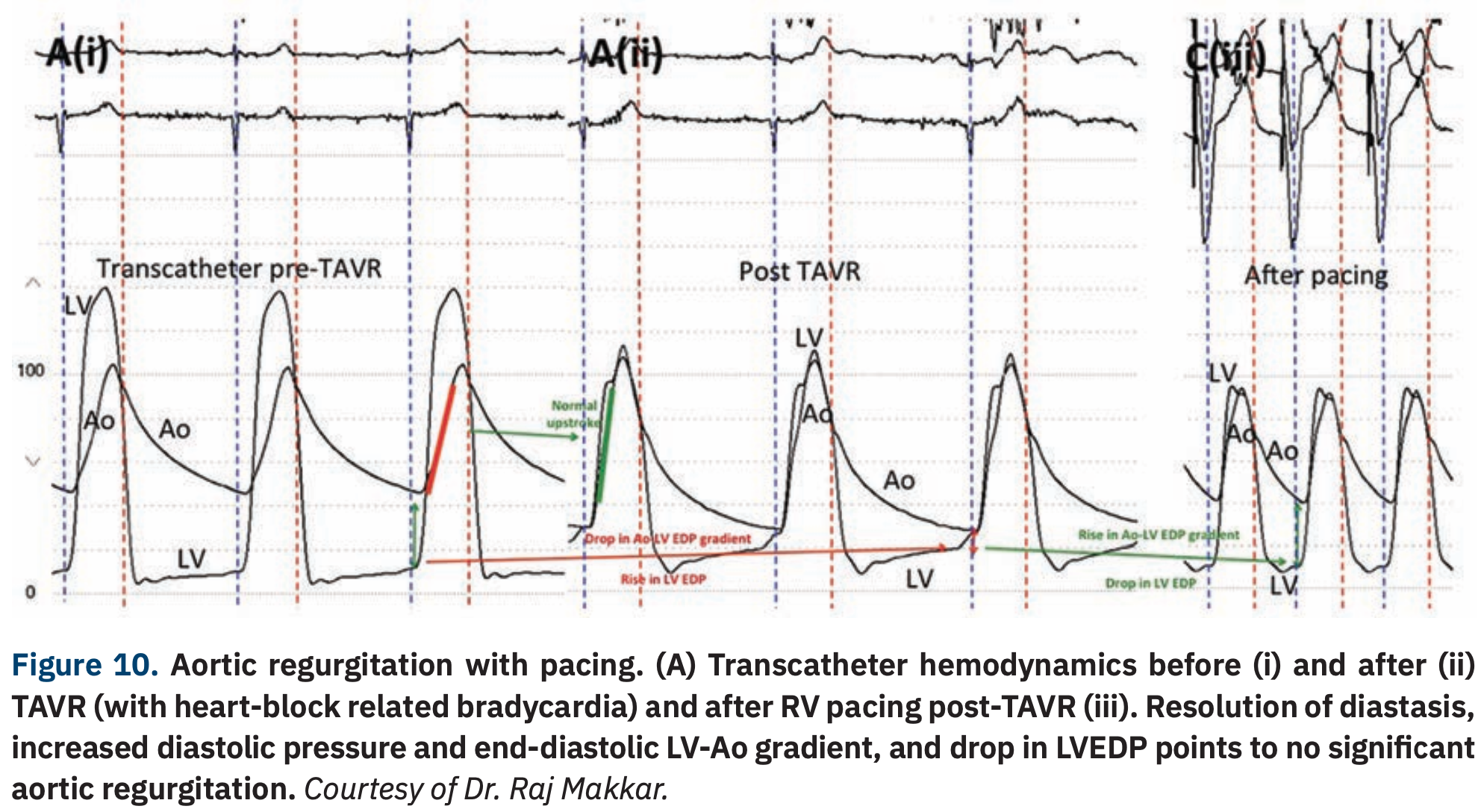 Hemodynamics That Can Make For a Lifesaving Decision in the Cath Lab